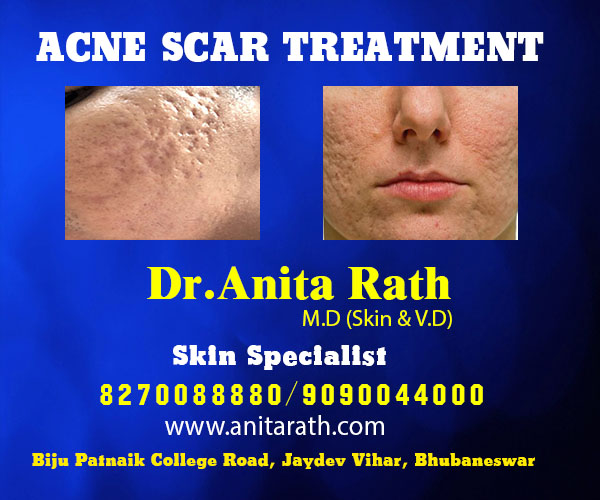 best acne & pimples treatment clinic in bhubaneswar near me
